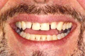 Man's unevenly spaced teeth