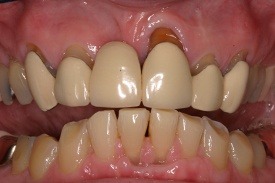 Smile with sever dental damage and discoloration