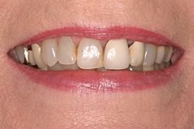 Closeup of darkly colored teeth
