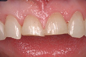 Closeup of two top teeth shorter than smile