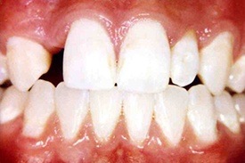 Smile with large gaps between teeth