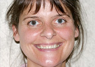 Woman's smile after treatment