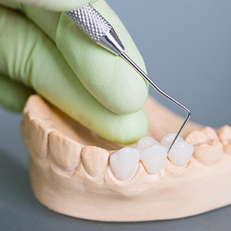 Model smile with dental bridge