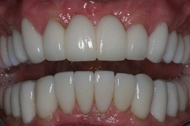 Healthy beautiful smile after treatment