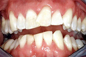 Man's crooked smile before treatment
