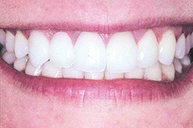 Woman's white flawless teeth