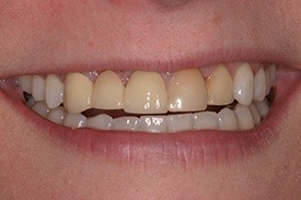 Woman's yellow flawed teeth