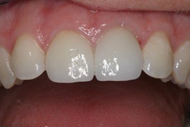 Closeup of white top teeth after