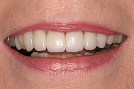 Closeup of beautiful white smile