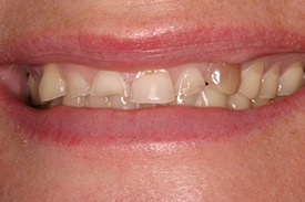Closeup of smile with unevenly sized teeth