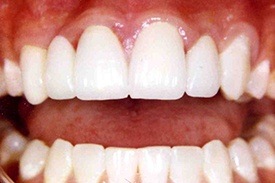 Smile with even  spacing between teeth