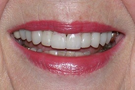 Closeup of beautiful white smile