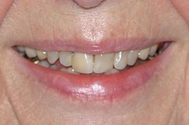 Closeup of dark yellowed teeth