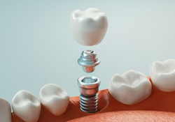 Diagram of dental implant parts in Farmington 