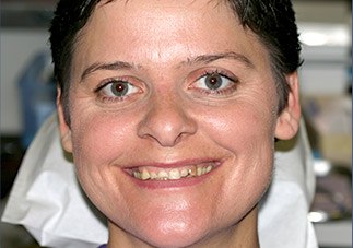 Woman's smile before treatment