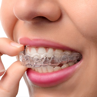 Closeup of person placing Invisalign tray