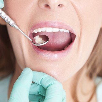 Closeup of patient receiving dental treatment