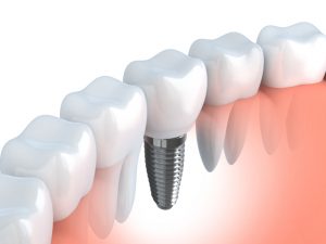 Dental implants in Farmington replace missing teeth better than other prosthetics. Dr. Leslie Metzger recommends implants to patients in good oral health.