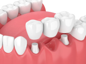 Side view of dental crown or bridge