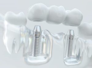 Dental bridge with implants