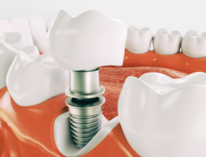 Dental implant