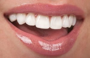 Beautiful smile with pristine porcelain veneers