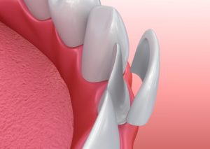 Model of a tooth prepped for a veneer