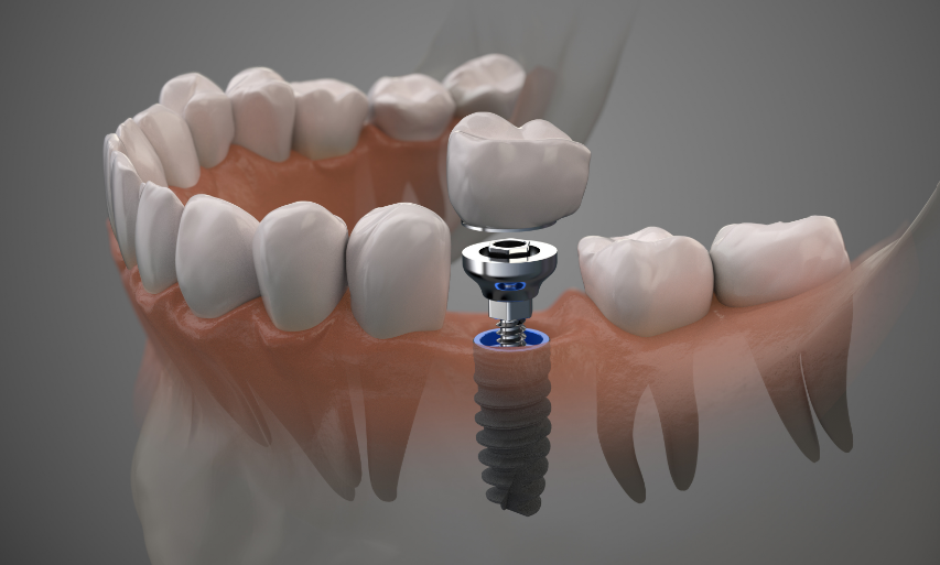3D image of a dental implant